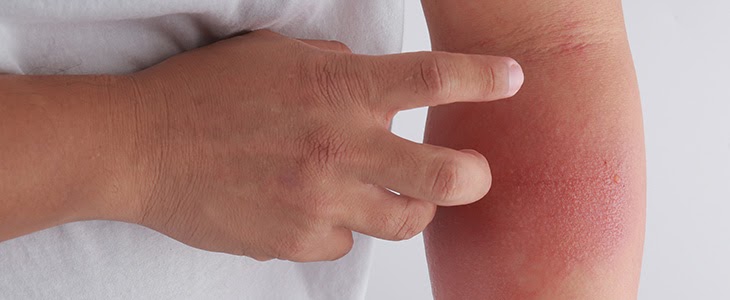 Dermatite Atópica – Saiba tudo sobre o assunto